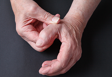patient holding his thumb in pain due to basal joint arthritis