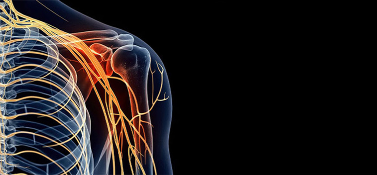 patient experiencing Brachial Plexus Neuropathy and in need of the neuropathy treatment protocol at Peak Physical Medicine and Wellness in Fort Worth