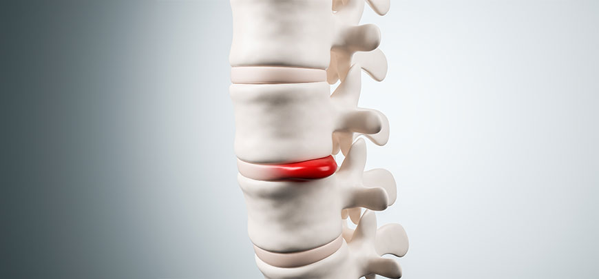patient experiencing Herniated Disc and in need of Advanced Joint Pain Relief