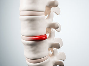 patient needing herniated disc