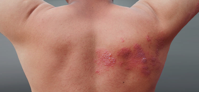 patient experiencing Post-Herpetic Neuralgia and in need of the neuropathy treatment protocol at Peak Physical Medicine and Wellness in Fort Worth