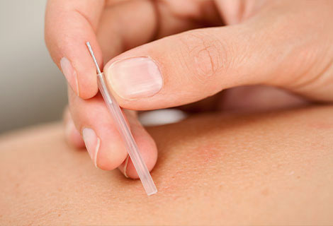 dry needling in Fort Worth TX