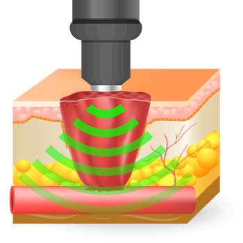 softWave is applied to the injured area